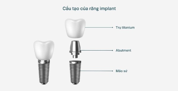 Implant của Đức