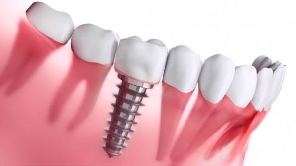Implant Hiossen Mỹ là gì
