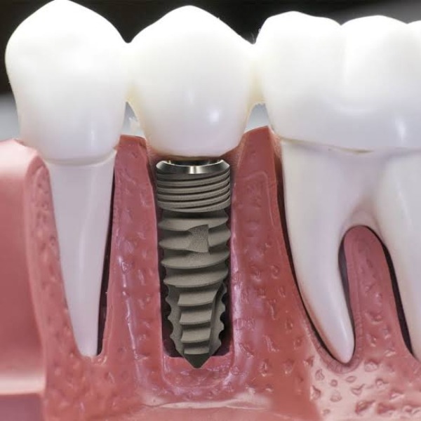 Cấy implant không rạch lợi