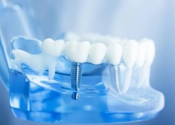 Mão (giả thế) trên implant an toàn MRI không