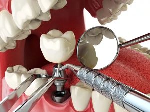 Quy trình phẫu thuật implant chân bướm