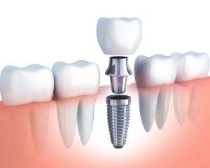 Osstem có tỷ lệ thành công cao
