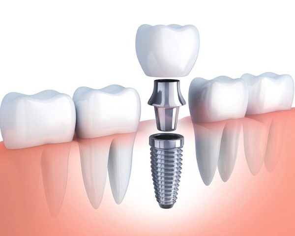 Osstem có tỷ lệ thành công cao
