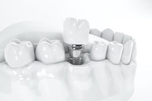 Implant pháp