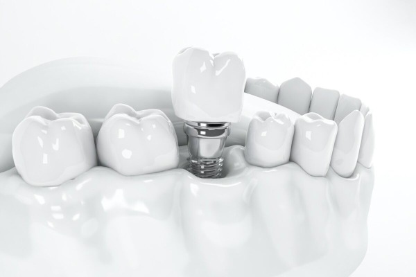 Implant pháp
