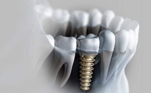 Implant bị đào thải