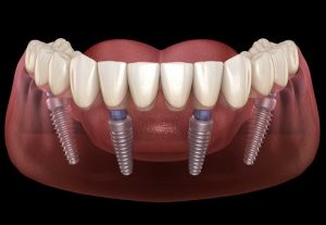 Implant toàn hàm bao nhiêu tiền
