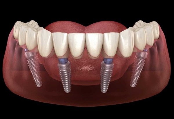 Implant toàn hàm bao nhiêu tiền