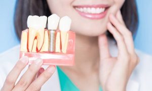 Trụ implant có thể tồn tại trọn đời nếu chăm sóc đúng