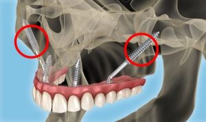 Implant chân bướm