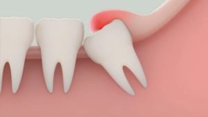 Uống thuốc sau khi nhổ răng khôn