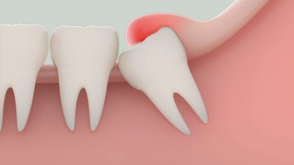 Uống thuốc sau khi nhổ răng khôn