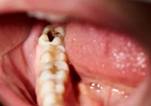 Lỗ nhổ răng khôn hình thành ra sao