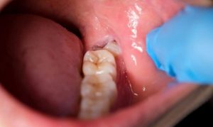 nhổ năng khôn nếu nó mọc lệch