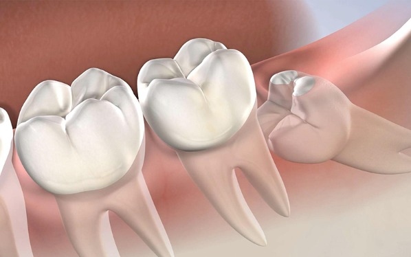 Đẩy lệch răng số 7 kế bên, ảnh hưởng cắn