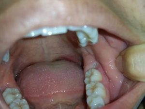 Thời gian hồi phục bình thường sau nhổ răng khôn