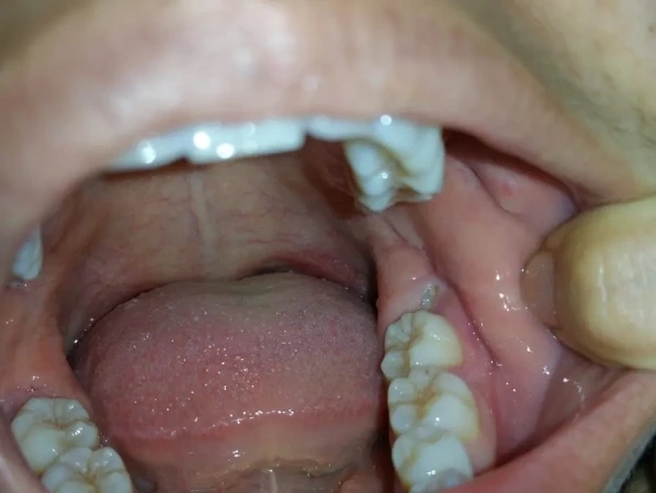 Thời gian hồi phục bình thường sau nhổ răng khôn