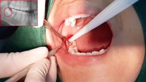 Chỉ tự tiêu tự tan sau 7-21 ngày không cần tháo