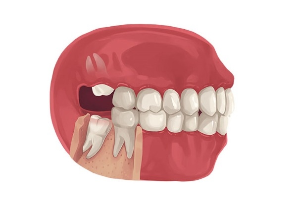 Tại sao xương hàm không còn chỗ cho răng khôn