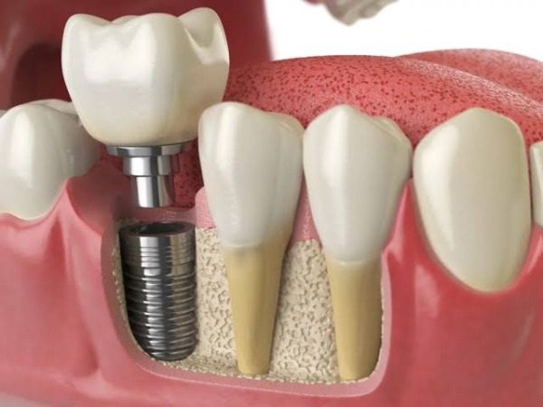 implant toàn hàm là gì
