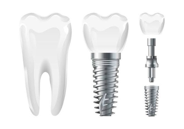 Cách chọn Implant