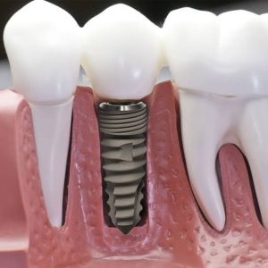 Cấy ghép Implant