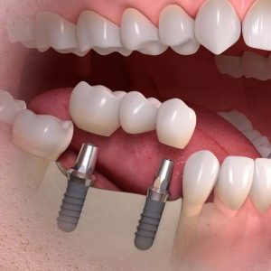 Implant chịu lực ngay sau khi cắm