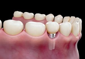 Tỷ lệ thành công và tuổi thọ của từng loại implant là bao nhiêu?