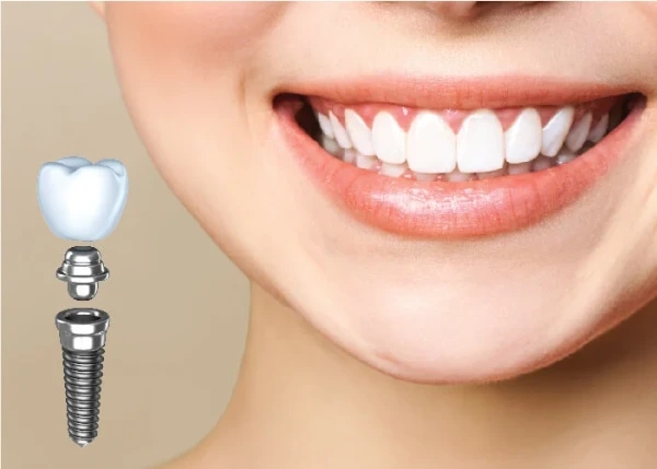 Lực siết Implant