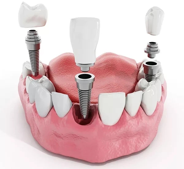 Vai trò mô mềm quanh implant và tại sao phải ghép