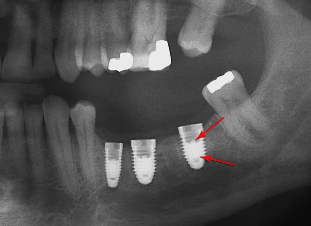 implant torque ncm