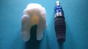 implant loại nào tốt nhất