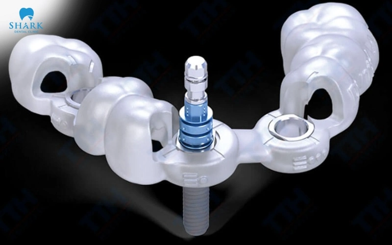 Máng hướng dẫn phẫu thuật implant