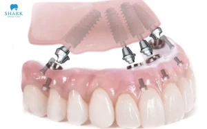 Tại sao chọn implant cũng cần hiểu chất liệu?