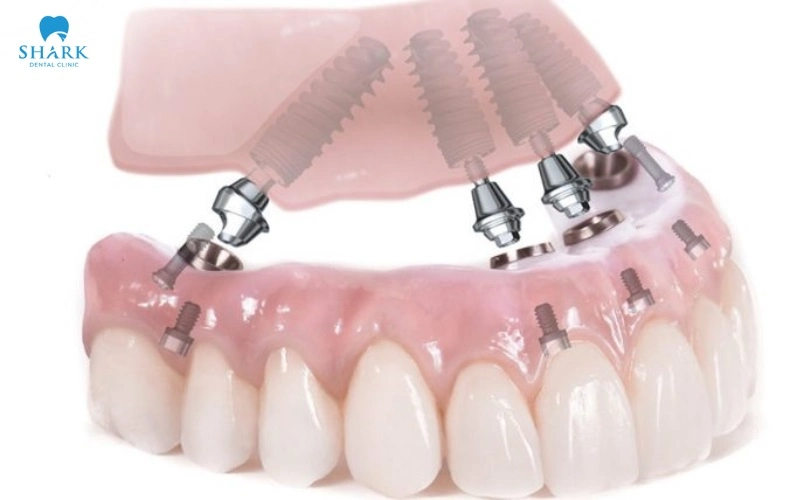 Tại sao chọn implant cũng cần hiểu chất liệu?