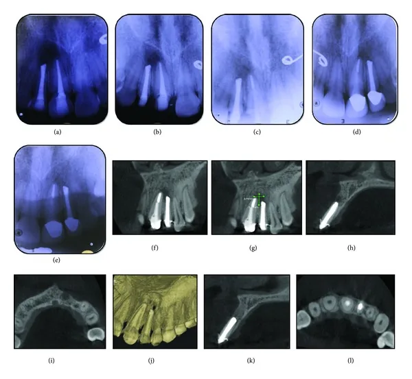 Phim X-quang và CBCT dùng để đánh giá implant