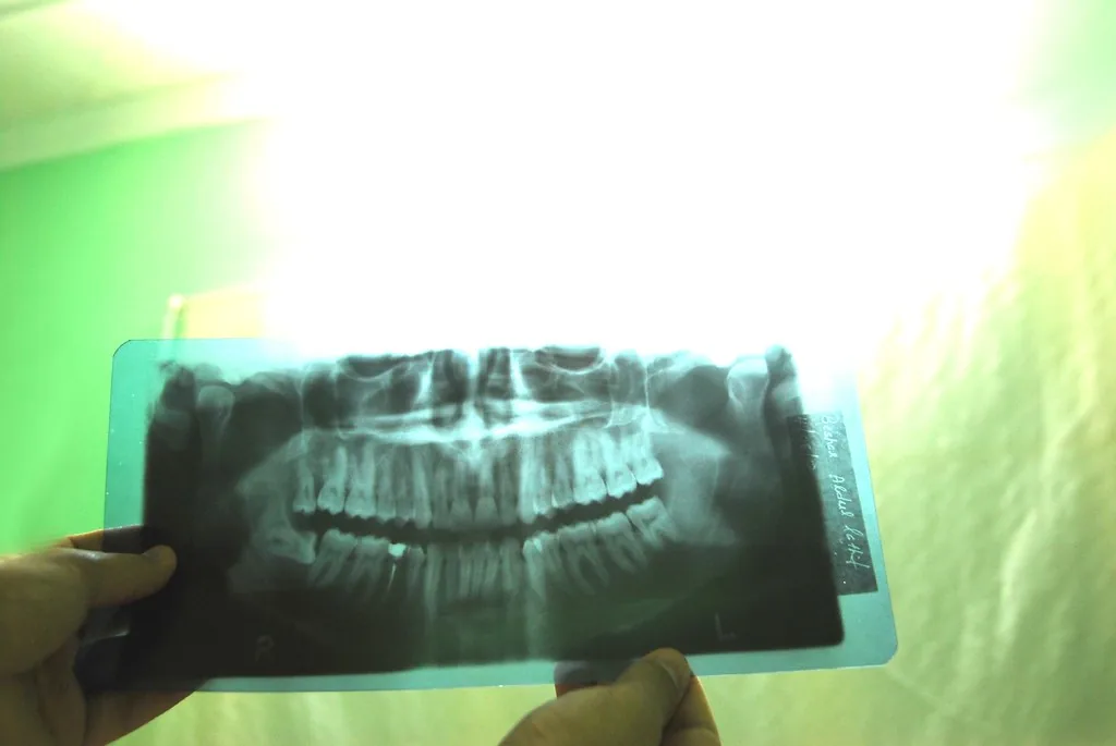 Chảy máu nướu quanh implant gợi ý viêm niêm mạc
