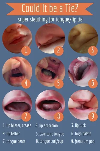 Bác sĩ khám nướu quanh implant để chẩn đoán viêm